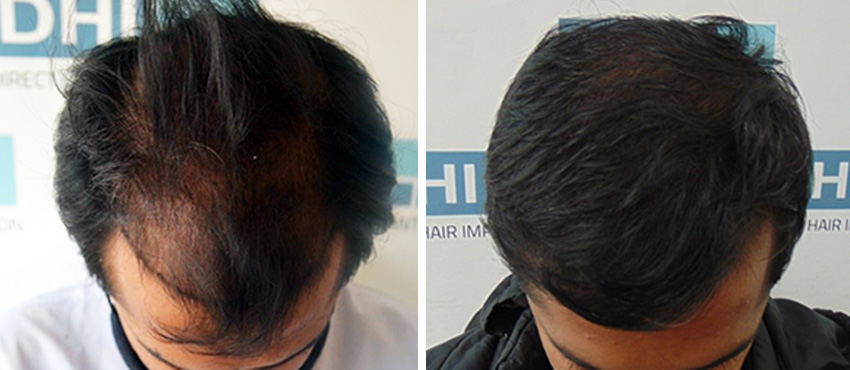 DHI before & after hair transplant results